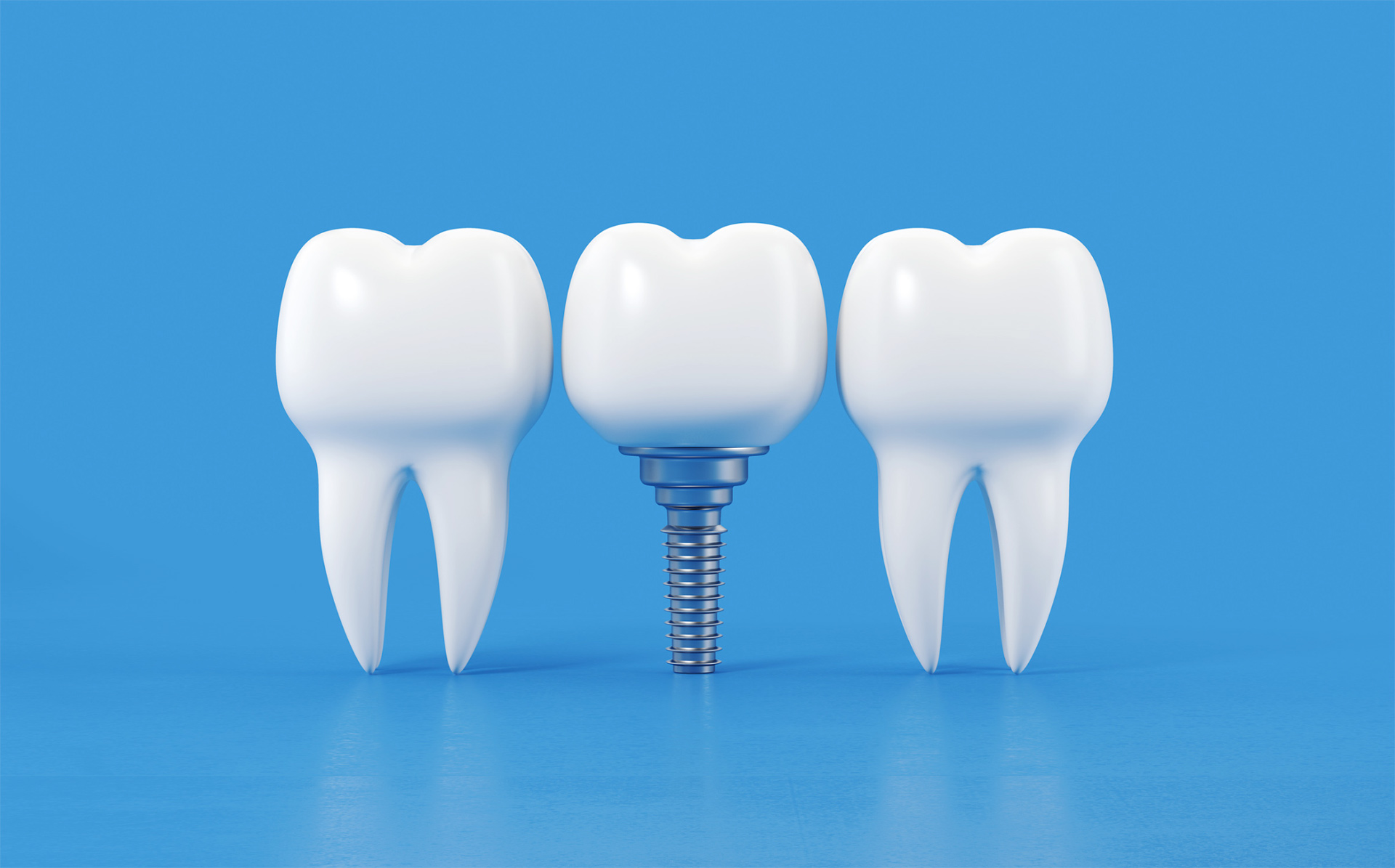 What is a Dental Implant?