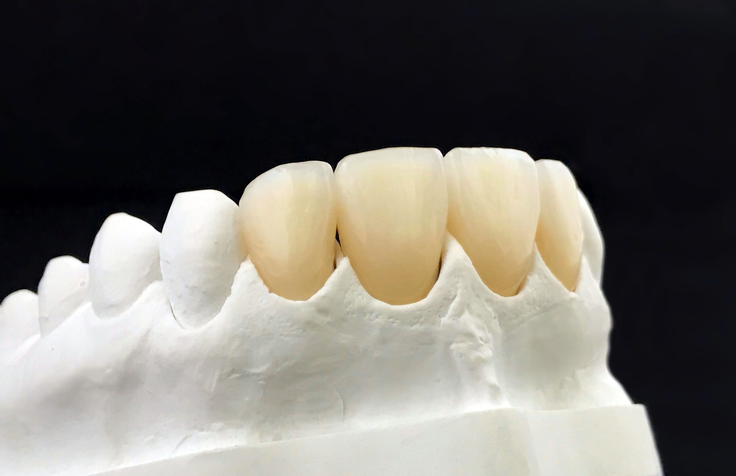 The Rise of Zirconia in Dentistry