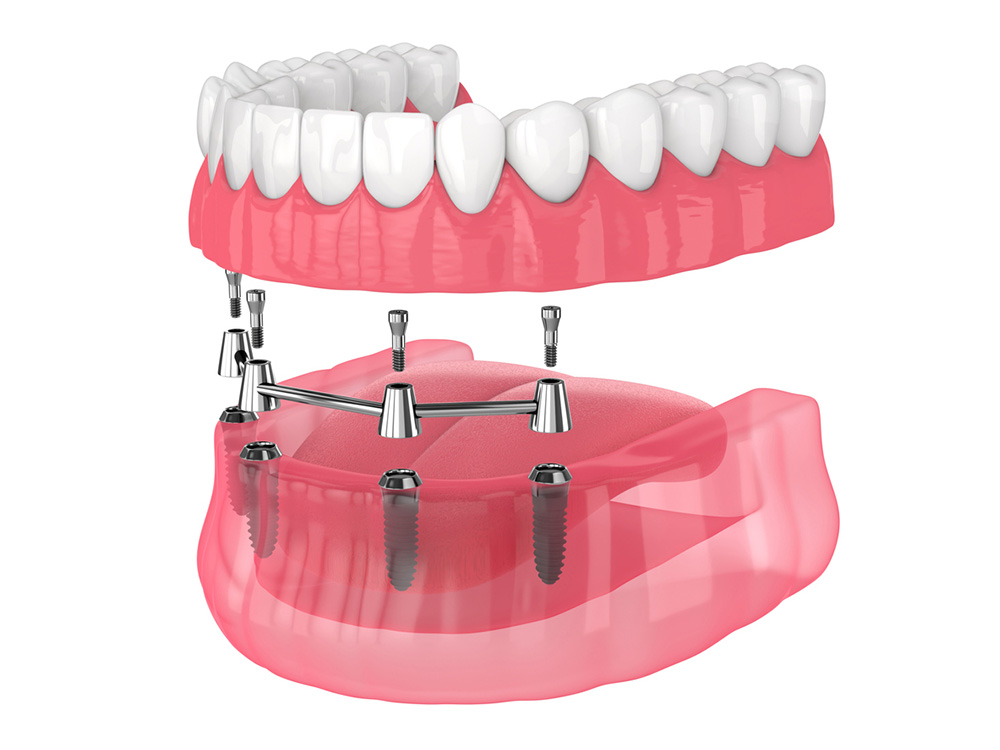 The All-on-4 Dental Implant System: A Life-Changing Solution for Full-Arch Restoration