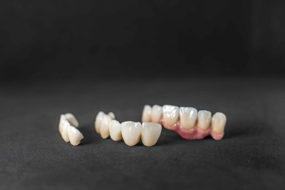 What Is a Dental Bridge?
