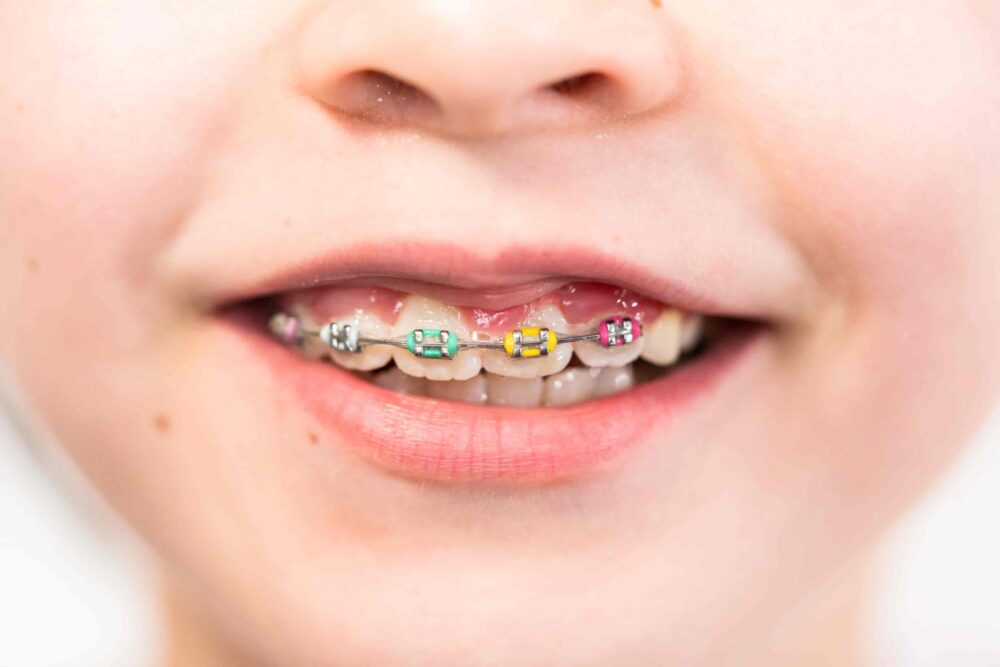 The Best Age for Orthodontic Treatment: When to Start and Why It’s Never Too Late