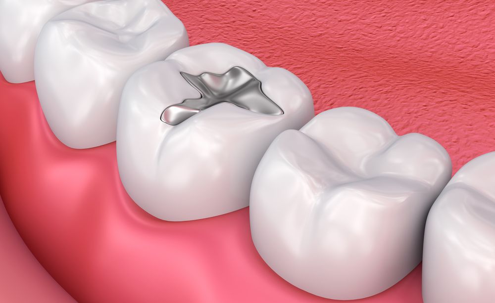 Is It Time to Replace Your Silver Fillings?