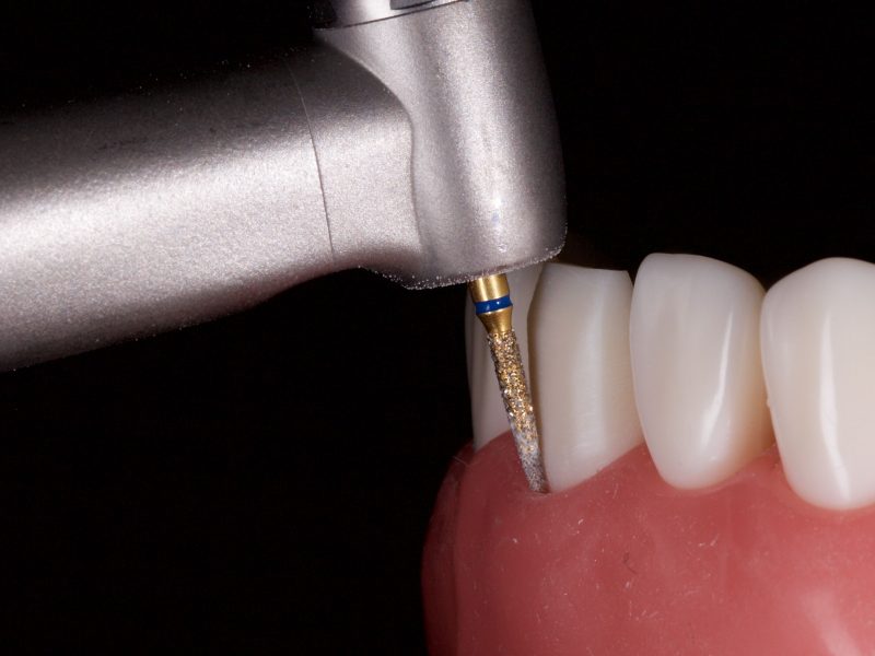 VertiPrep and BOPT: The Future of Dental Crown Restorations