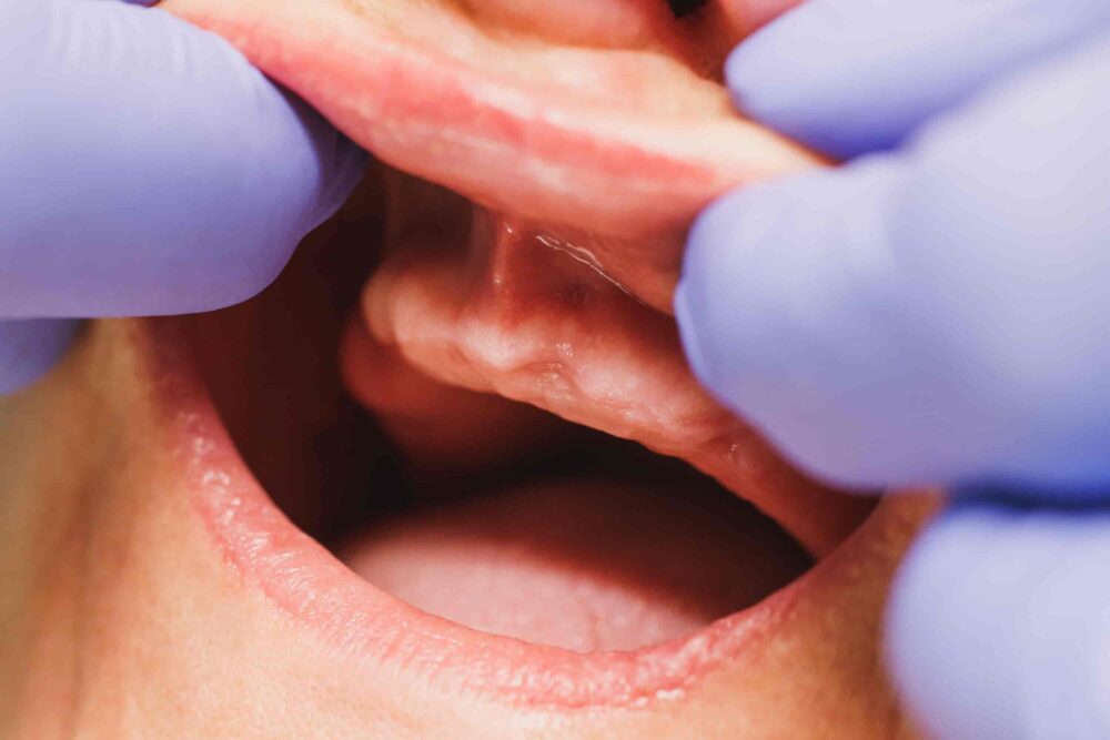 Cleft Palate and Dentistry: What You Should Know