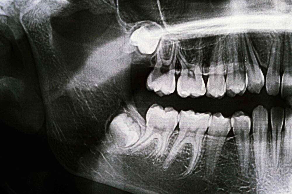 Why Do People Get Wisdom Teeth? A Look at Your Third Molars